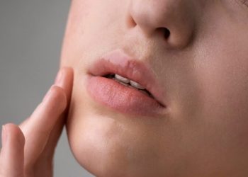 Penyebab Bibir Pecah-Pecah dan Cara Mengatasinya Secara Alami