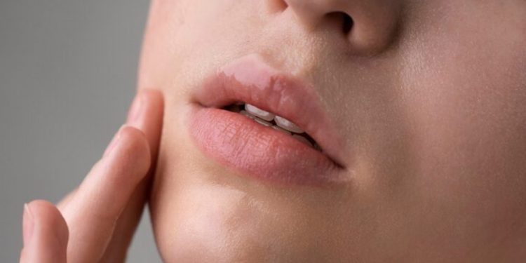 Penyebab Bibir Pecah-Pecah dan Cara Mengatasinya Secara Alami