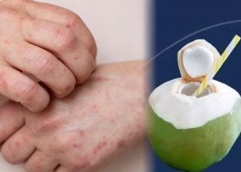 Jangan Salah! Air Kelapa Hijau Bukan Obat Cacar pada Anak
