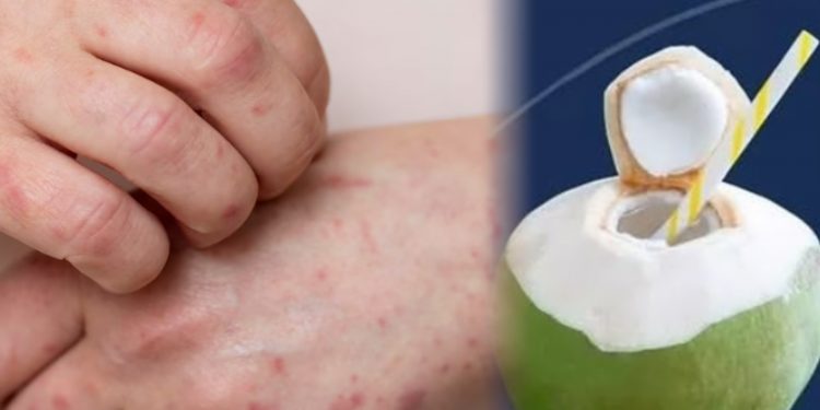 Jangan Salah! Air Kelapa Hijau Bukan Obat Cacar pada Anak